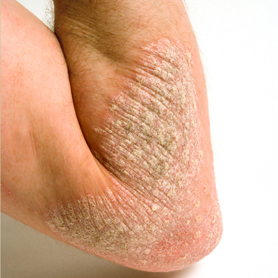psoriazis2