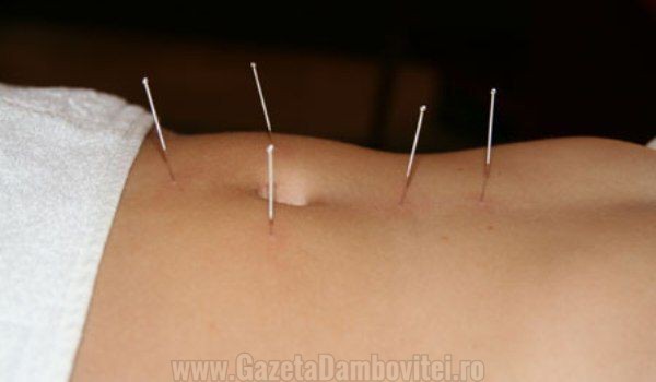 acupunctura1