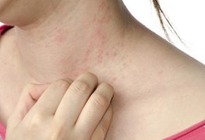 eczema skin on neck