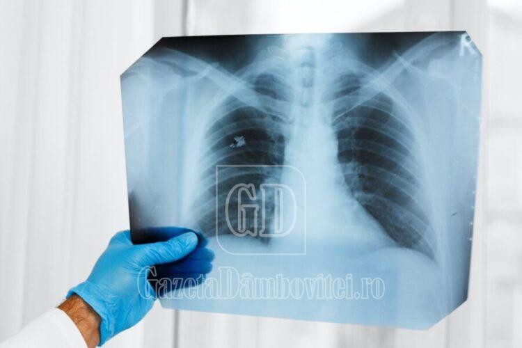 radiografie plamani