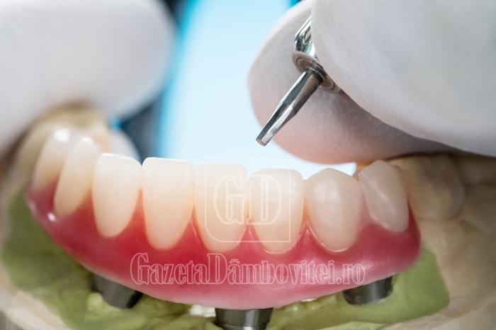 closeup/,dental,implants,supported,overdenture,on,blue,background.