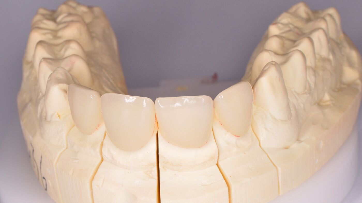 fa ete bonding i albire intr o singura clinica cum abordeaza atelierul de zambete estetica dentara in sector 3 bucure ti3