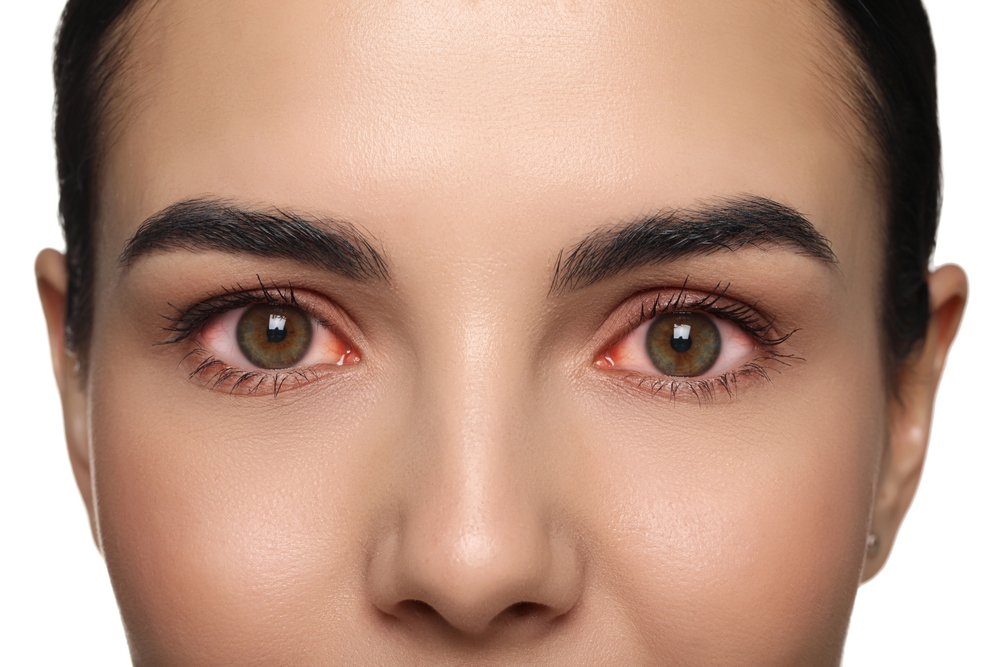 woman,with,red,eyes,suffering,from,conjunctivitis,on,white,background,